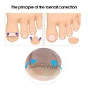 12Pcs Ingrown Toenail Correction Wire Fixer Ingrown Toe Nail Corrector Pedicure Treatment Foot Care Tool