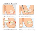 120Pcs Ingrown Toenail Straightening Clip Ingrown Toenail Correction Elastic Patches Paronychia Acronyx Correction Patch Foot Ca