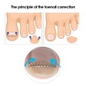 12Pcs/Box Ingrown Toenail Correction Wire Fixer