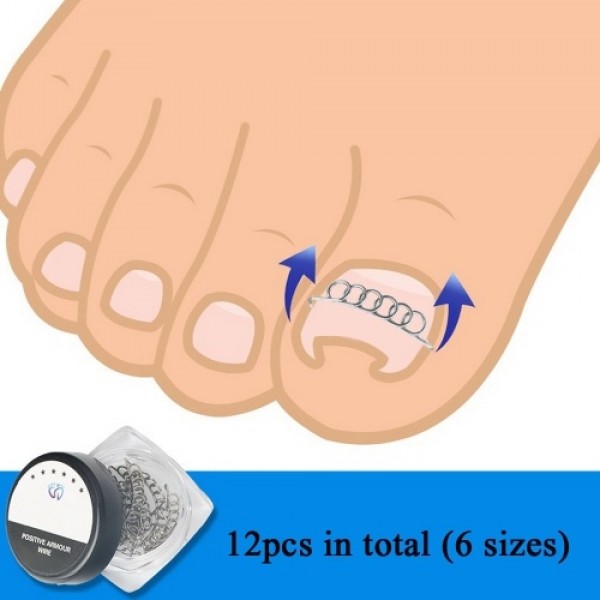 12Pcs/Box Ingrown Toenail Correction Wire Fixer