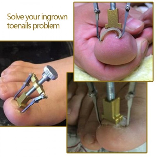 Professional Ingrown Toe Nail Correction Tool Toenail Treatment Pedicure Tool Nail Care Tool